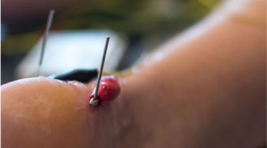 Neuromodulación Percutánea